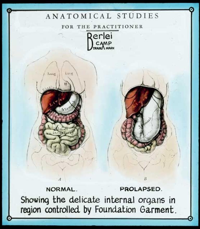 Anatomical diagrams comparing the 'delicate internal organs' of a woman who wears a foundation garment and one who doesn't. The one who doesn't has organs which have been labelled as 'prolapsed'.