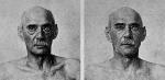 Side by side head and shoulder photos of the same elderly man before and after an operation. c1922